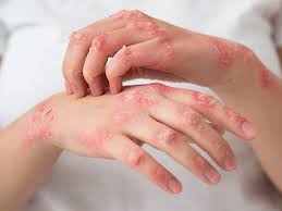 Da trẻ bị ngứa, da khô, mẫn đỏ, xuất hiện mụn nước